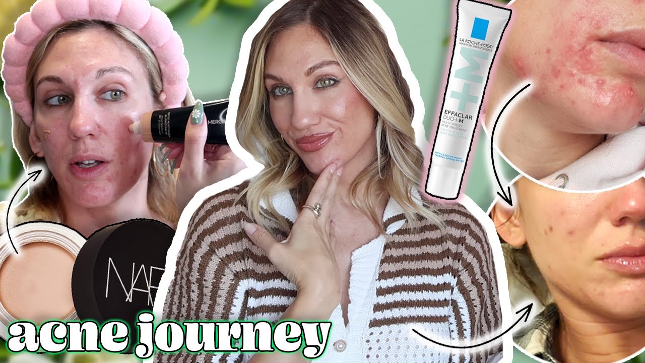 if i could do my acne journey differently ...