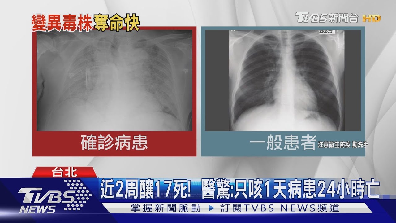 近2周釀17死!醫:病患肺「全白浸潤」只咳1天24小時亡