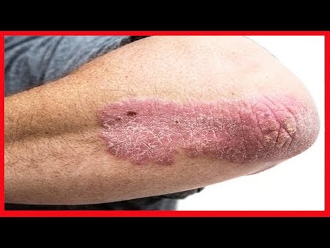 A cera de creme é sã da psoríase em Karaganda Curei o eczema em dedos de mãos