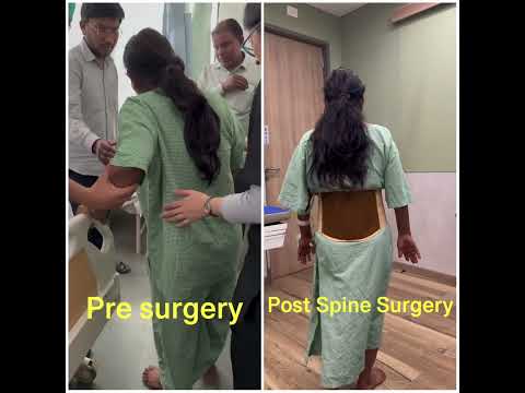 Endoscopic Spine treatment : New life to patients 