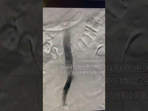 How I deploy an #ivcfilter (irad  / #radiology)