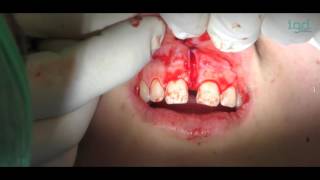 iDental | Frenectomía | Dr. Matía Marcón