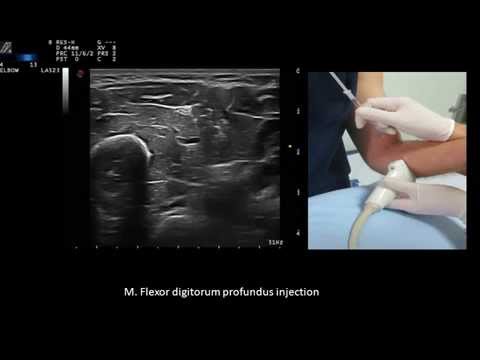 Ultrasound guided upper limb  botulinum toxin injections,  by Murat Karkucak MD