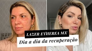 Fiz o Etherea MX - Melhor Laser Para Rejuvenescimento| Deusa Constanzi