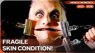 The Man With the World’s Stretchiest Skin | Medical Incredible