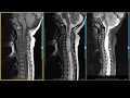 Cervical Spinal Cord Astrocytoma on MRI