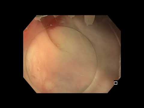 Colonoscopy: Resection of Sigmoid Colon Stalk