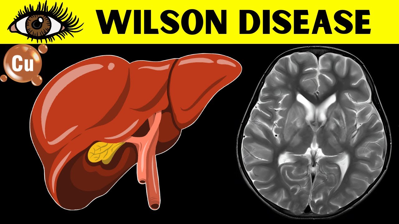 Wilson Disease - The Inherited Disorder Of Copper Metabolism - Everything You Need To Know