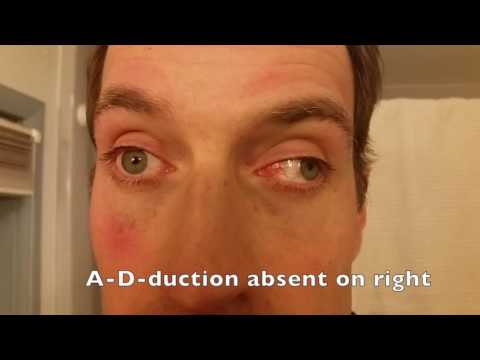 Reel-Example: Internuclear Ophthalmoplegia (MLF lesion on right)