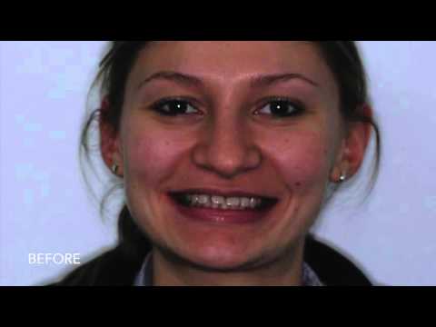 invisalign testimonial