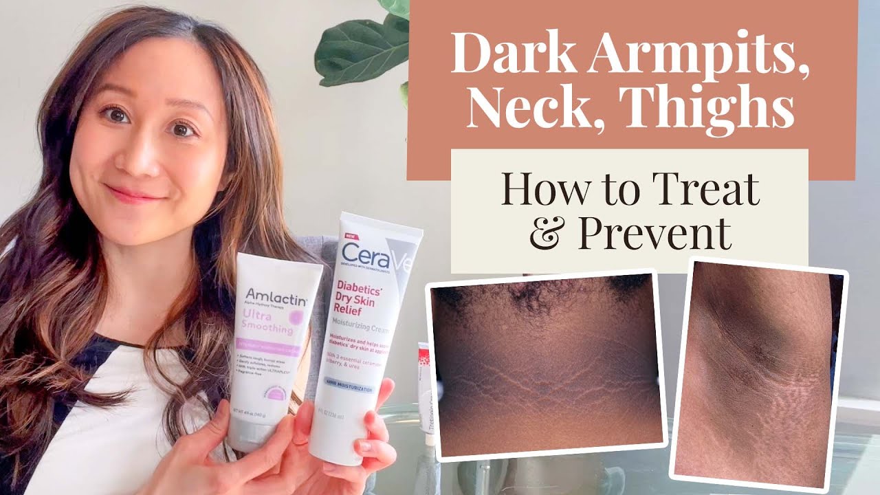 Treating and Preventing Dark Armpits, Thighs, Neck, and Arms | Dr. Jenny Liu