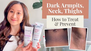 Treating and Preventing Dark Armpits, Thighs, Neck, and Arms | Dr. Jenny Liu