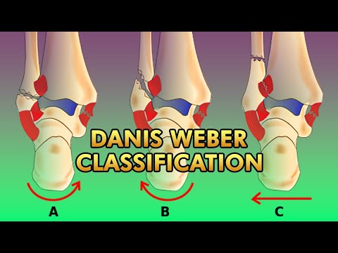 Danis Weber Classification of Malleolar Fractures of The Ankle