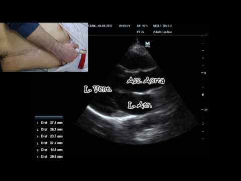 Point of Care Ultrasound for the Aorta