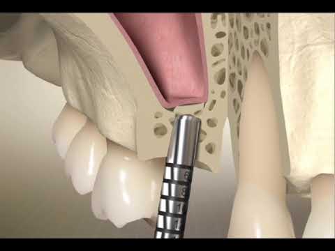 Transalveolar sinus lift