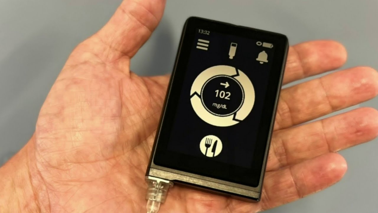 'Bionic Pancreas' to improve blood sugar control for diabetics