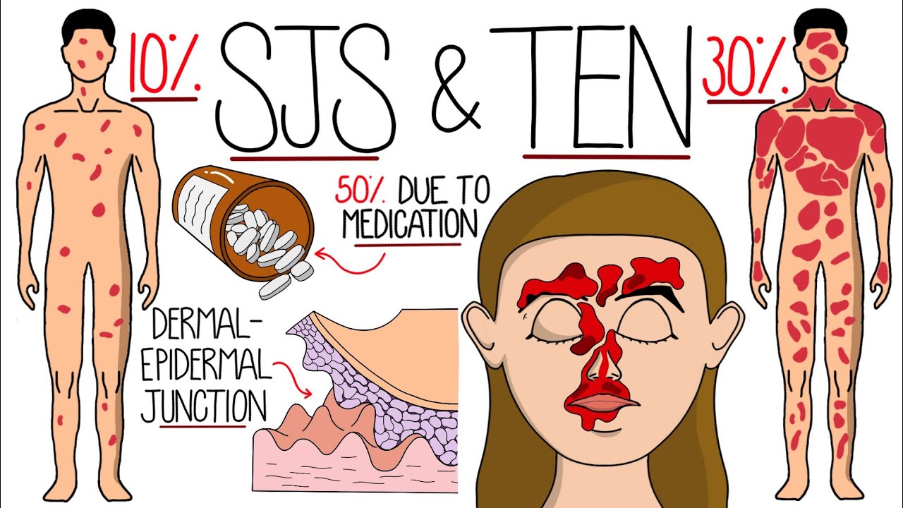 Understanding Stevens-Johnson Syndrome and Toxic Epidermal Necrolysis (SJS & TEN)
