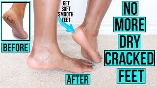 How to Get Rid of Dry Cracked Feet FAST & NATURALLY | AT HOME Remedies & MORE