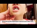 Katherine Lost Her Right Upper Central Incisor Baby Tooth