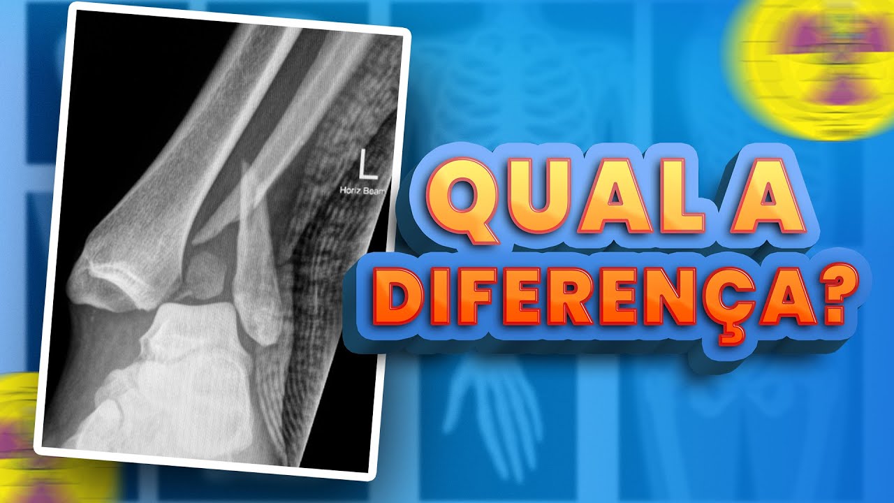 O QUE É CONTUSÃO ENTORSE LUXAÇÃO FISSURA E FRATURA?