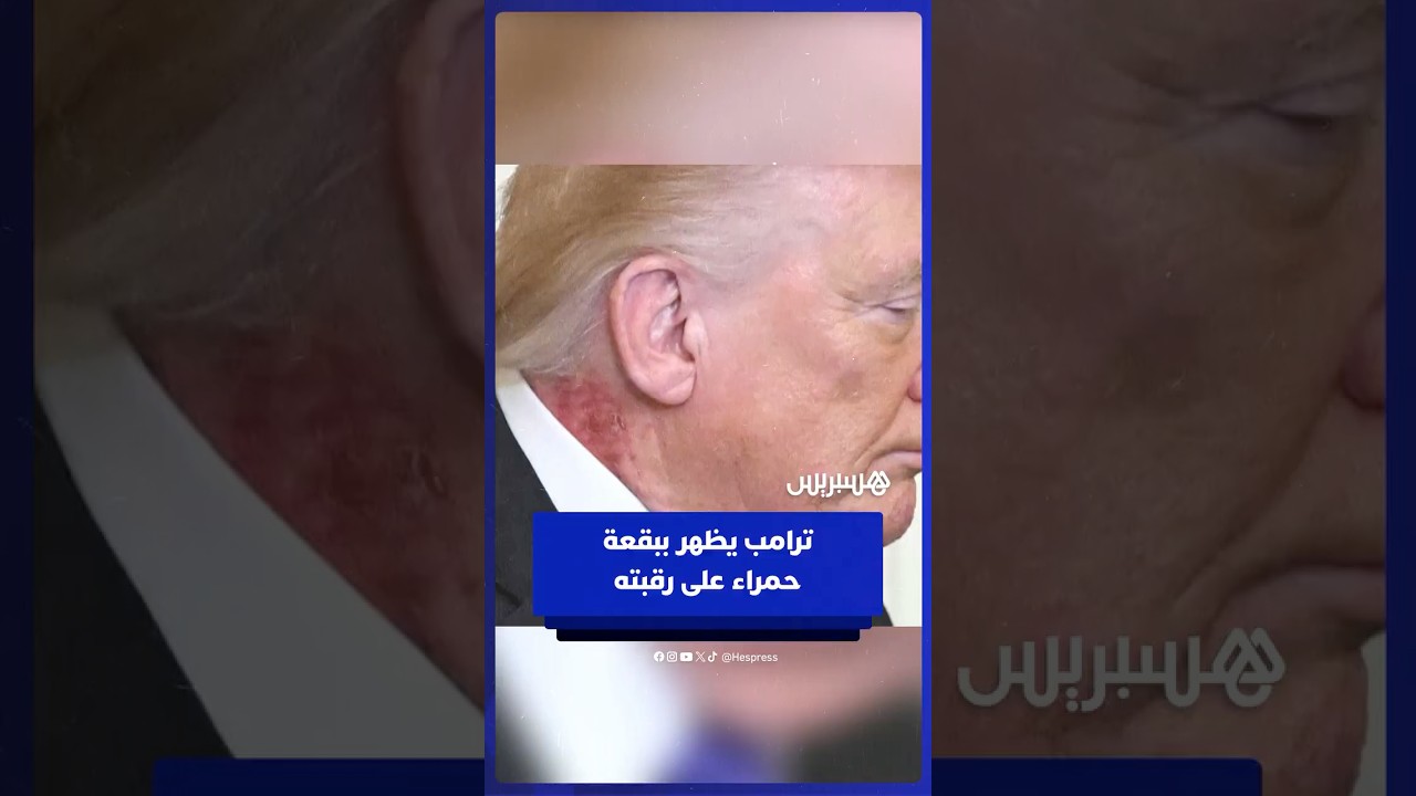 ظهور طفح جلدي أحمر على رقبة الرئيس الأمريكي دونالد ترامب خلال فعالية في البيت الأبيض thumbnail