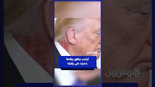 ظهور طفح جلدي أحمر على رقبة الرئيس الأمريكي دونالد ترامب خلال فعالية في البيت الأبيض thumbnail