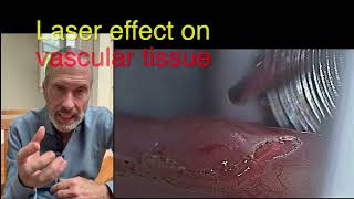 Nanomargin vocal cord tumor surgery