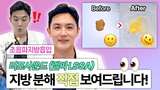 [JPN SUB] 초음파지방흡입 | 리포사운드(엘싸 LSSA) | 지방 분해 과정 직접 보여드릴게요!  | 얼굴지방흡입 | 이중턱지방흡입