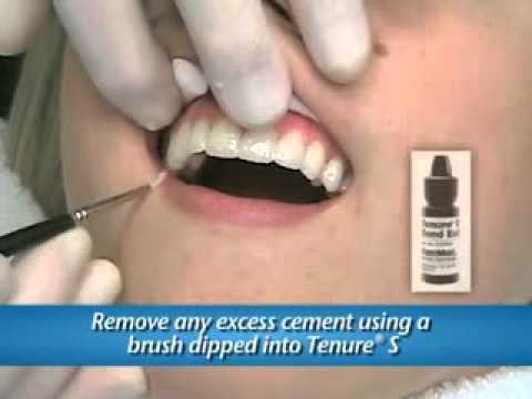 lumineers procedure.flv