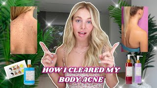 The TRUTH About How I Cured My Body Acne in 4 Steps!