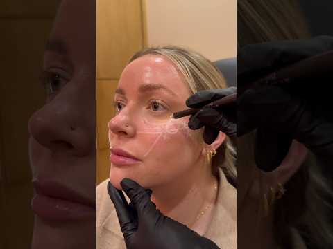 Facial Mapping for Cheek Filler #cheekfiller #cheekfillers #fillers #cosmeticnurse