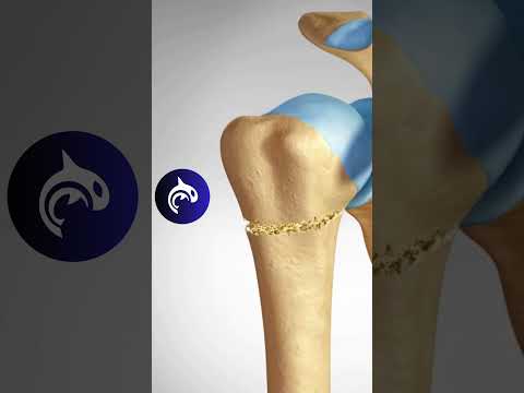 Shoulder Fracture: See Different Proximal Humeral Fractures in 3D #fracture #shoulder