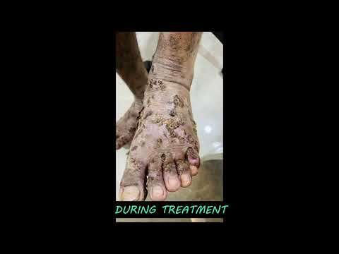 Eczema