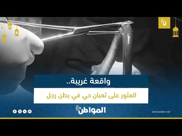 واقعة غريبة.. العثور على ثعبان حي في بطن رجل