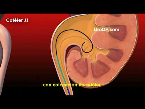 Catéter JJ