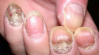 How To Treat Psoriasis of the Nails