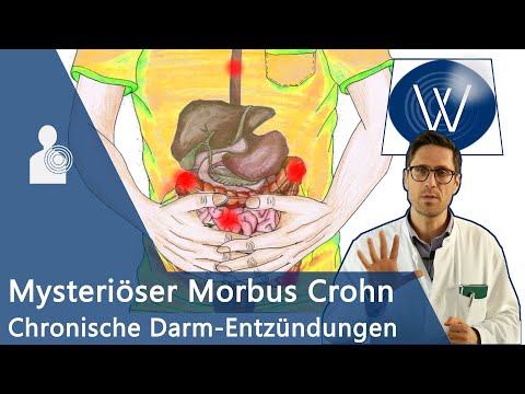 Morbus Crohn: Ursache für unblutigen Durchfall & Bauchschmerz? Chronisch-entzündliche Darmerkrankung