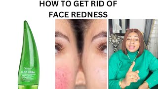 HOW TO GET RID OF FACE REDNESS FAST | Home remedy