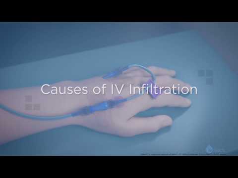Causes of IV Infiltration - Training Video