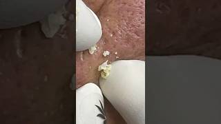 Acne with an odor in the nasal area 😅 #skincare #satisfying #blackhead #acne #shortvideo