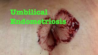 Umbilical (Belly Button) Endometriosis