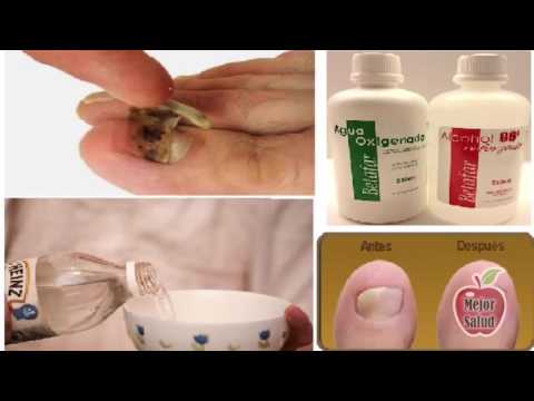 El hongo de las uñas en los pies que curar dermatofit La bioquímica del hongo de uña