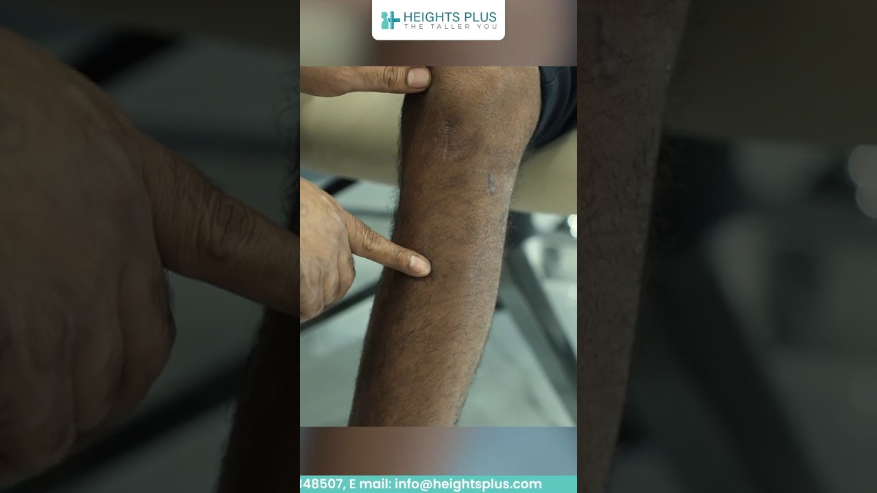 Scar Healing & Recovery Update | 1 Month After Frame Removal | Heights Plus