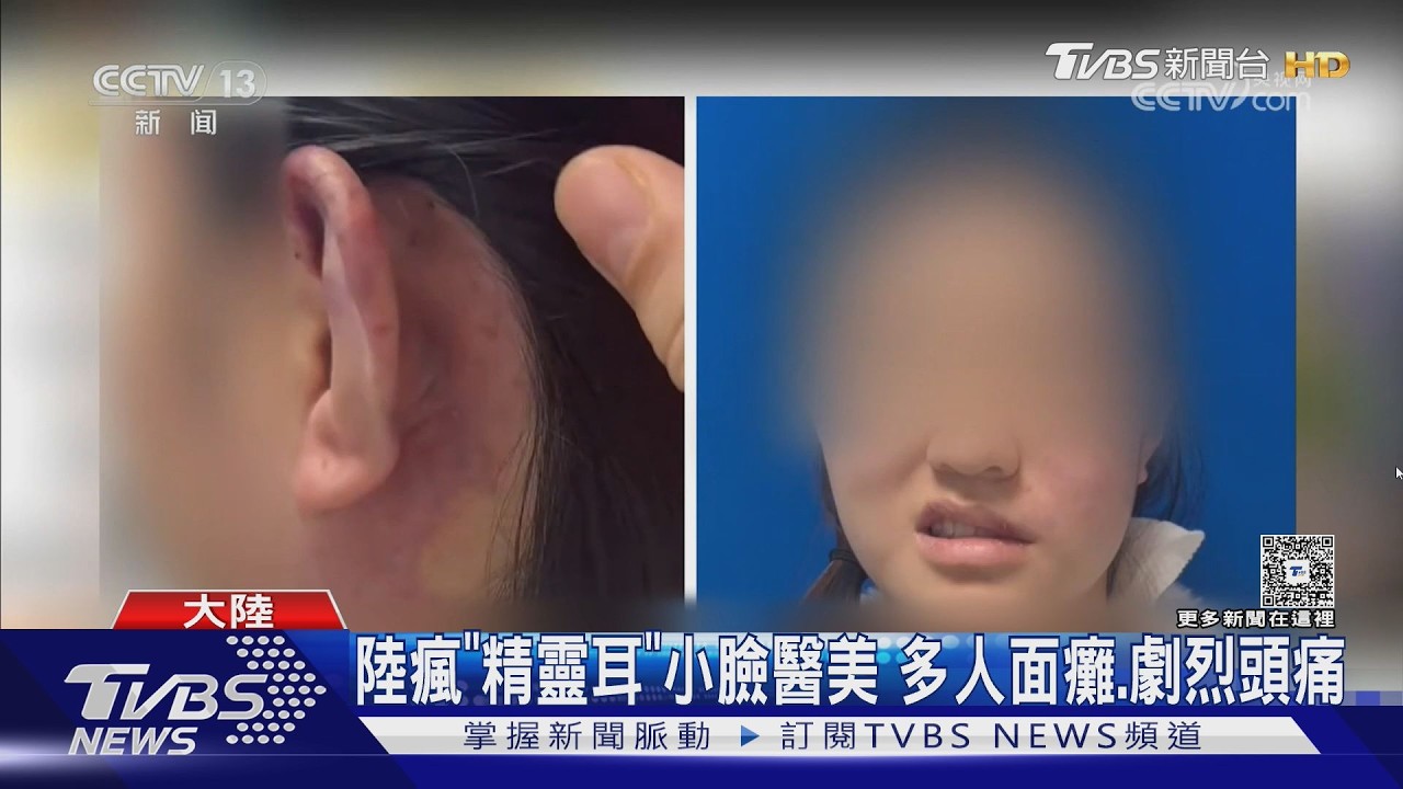 影音/陸瘋「精靈耳」醫美!女打玻尿酸臉癱 醫警告:如埋地雷