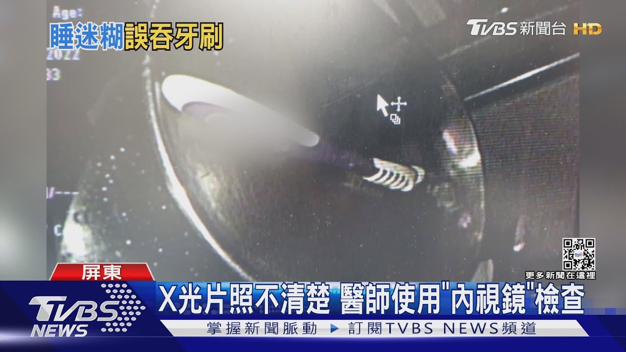 「深」喉嚨!女起床趕時間 誤吞18公分牙刷