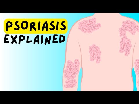 Does psoriasis get better with age