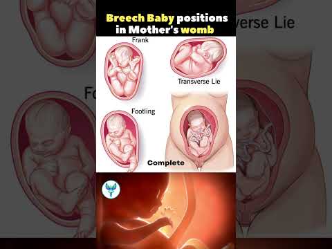 Breech Baby positions in Mother's womb | Baby in mother's belly | Pregnancy Tips