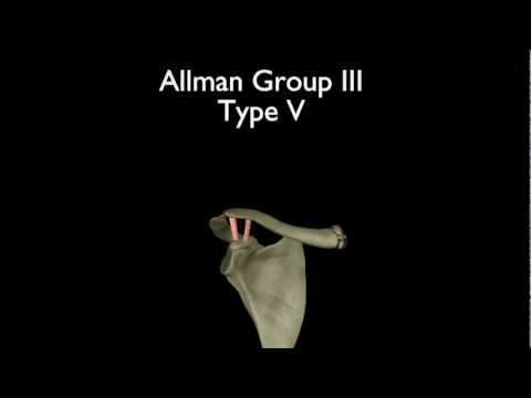 Clavicle Fractures:  Classification and Surgical Indications