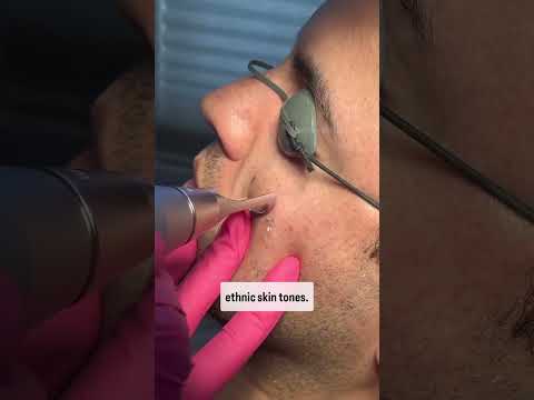 Pico Laser for Brown Spots #dermatology #picolaser