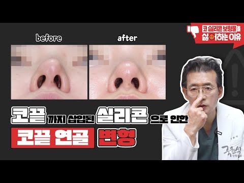 코 성형 후 코끝이 변형되었어요..!! 가장 확실하게 교정하는 방법은?